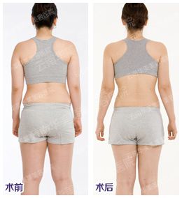吸脂前后对比图